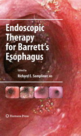 Endoscopic Therapy for Barrett's Esophagus