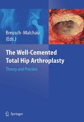 The Well-Cemented Total Hip Arthroplasty