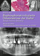 Bisphosphonat-induzierte Osteonekrose der Kiefer