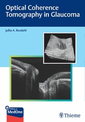 Optical Coherence Tomography in Glaucoma