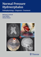 Normal Pressure Hydrocephalus