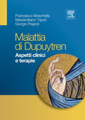 Malattia di Dupuytren